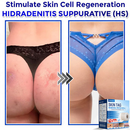 🌟Celsiora® Multi-Functional Microneedle Hydrocolloid Patch Roll | Targets Skin Tags, Warts & Stubborn Blemishes