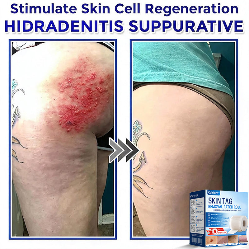🌟Celsiora® Multi-Functional Microneedle Hydrocolloid Patch Roll | Targets Skin Tags, Warts & Stubborn Blemishes